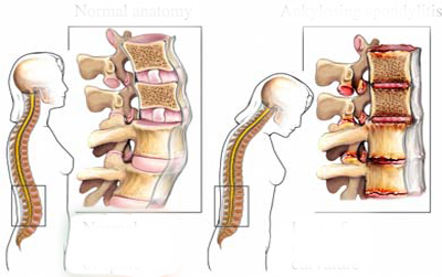 Viêm cơ dính khớp là gì?