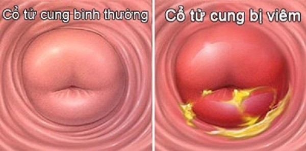 Viêm cổ tử cung là một trong những căn bệnh phụ khoa