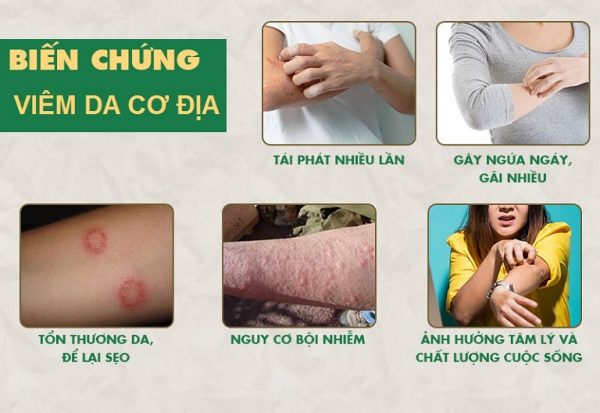 Viêm da cơ địa có lây không? Bệnh thường xảy ra ở trẻ em