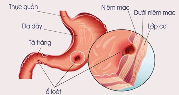 Viêm dạ dày khác loét dạ dày như thế nào?