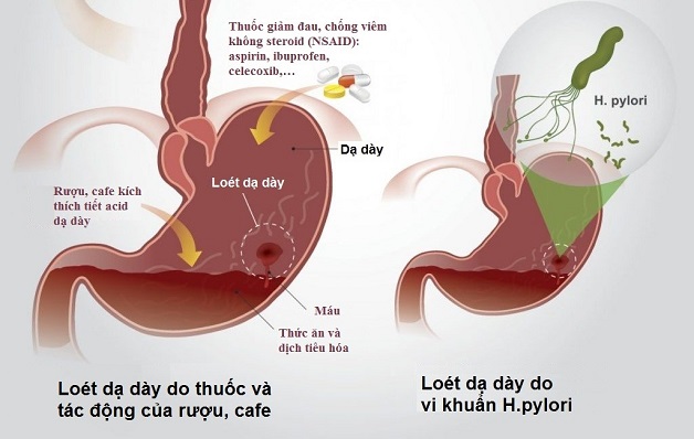 Viêm dạ dày tá tràng và những điều bạn cần biết