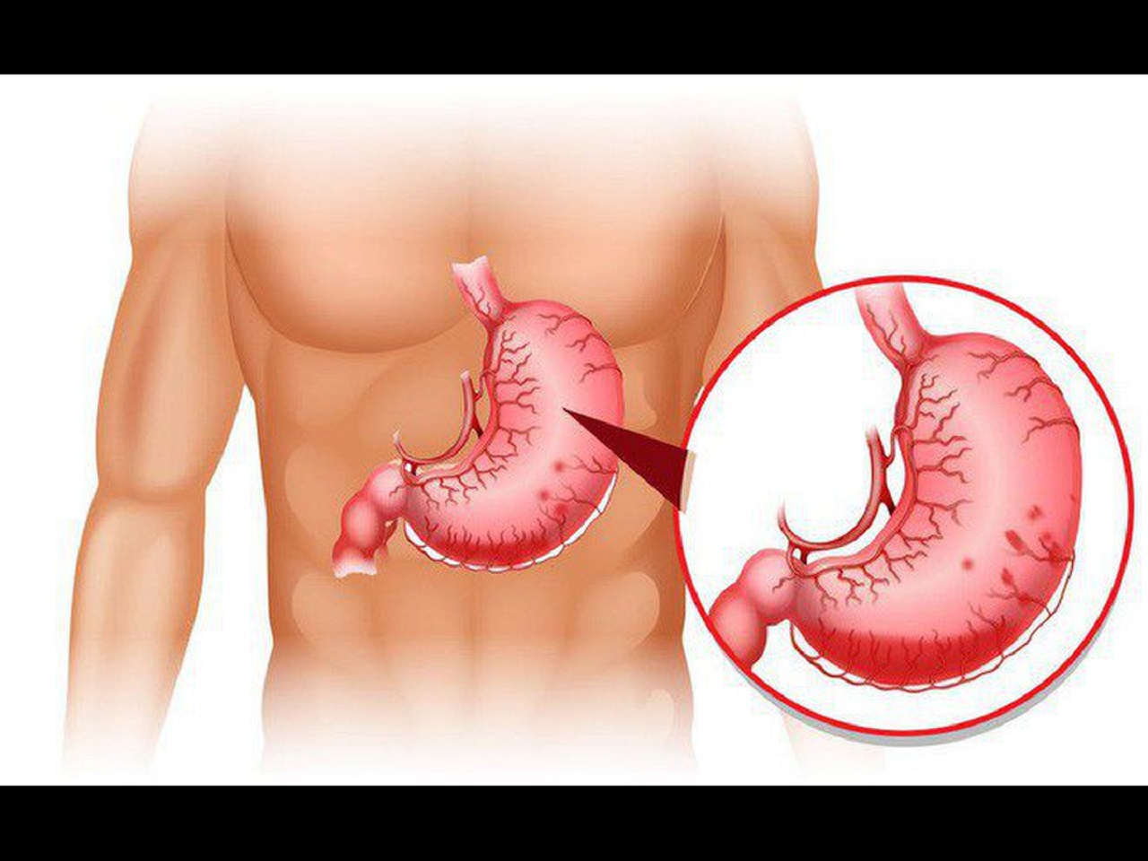 Viêm dạ dày và tá tràng và những kiến thức cần biết 