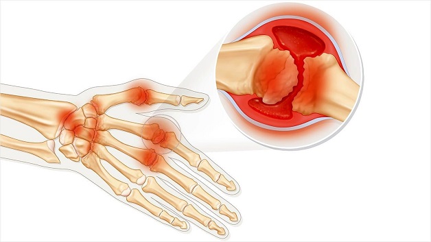 Viêm đa khớp dạng thấp: Nguyên nhân và triệu chứng