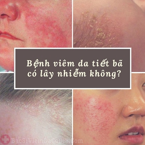 Viêm da tiết bã nhờn có lây không?