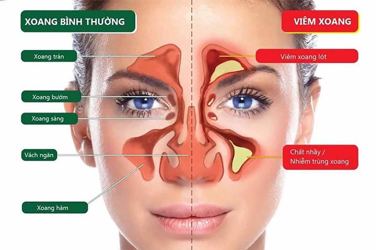 Viêm đa xoang mãn tính: Nguyên nhân và triệu chứng