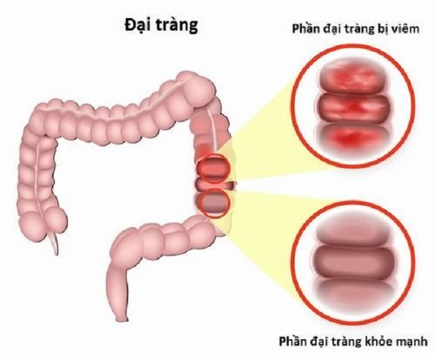 viem dai trang cap tinh 1