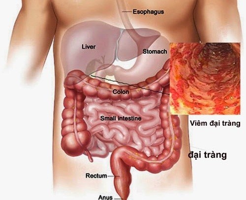 Viêm đại tràng co thắt là bệnh phổ biến, thường gây đau