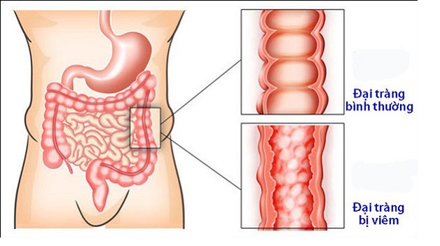 Viêm đại tràng co thắt là gì? Cách chữa ra sao?