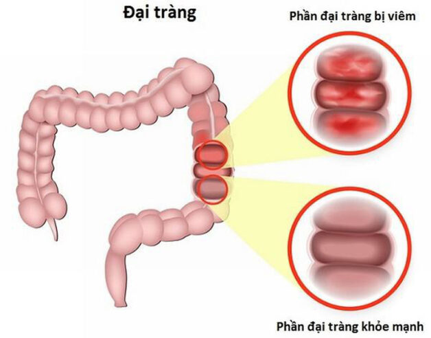 Viêm đại tràng co thắt – nguyên nhân và triệu chứng