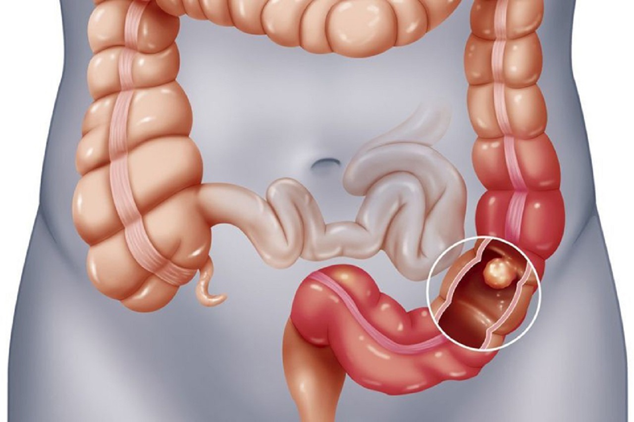 Viêm đại tràng điều trị sao đúng cách phòng biến chứng nguy hiểm