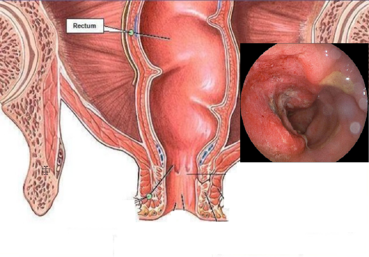 Viêm đại tràng không xác định là gì? Cách điều trị