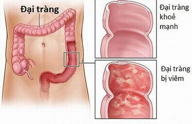 viem dai trang khong xac dinh