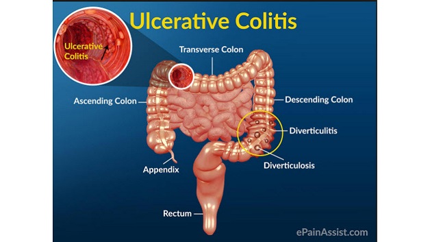 Viêm đại tràng: Nguyên nhân, dấu hiệu nhận biết bệnh