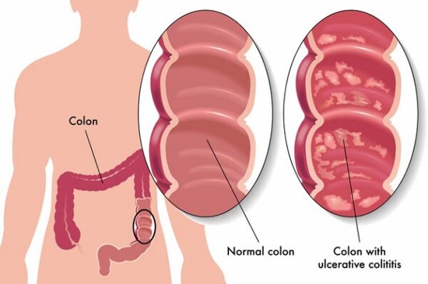 Viêm đại tràng: Nguyên nhân, dấu hiệu nhận biết bệnh