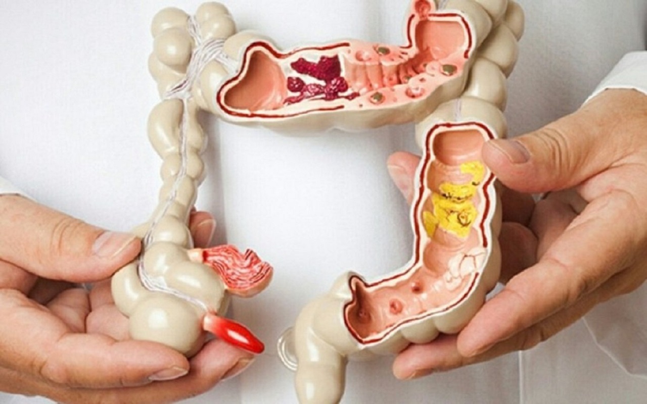 Viêm đại tràng polyp – Những kiến thức cần biết