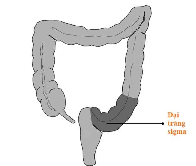 Viêm đại tràng sigma là gì? Triệu chứng và cách điều trị