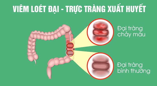 Viêm đại tràng xuất huyết: những biến chứng khó lường