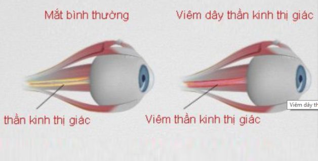 Viêm dây thần kinh mắt có nguy hiểm không?