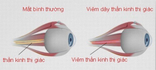 Viêm dây thần kinh thị giác nguy hiểm không?