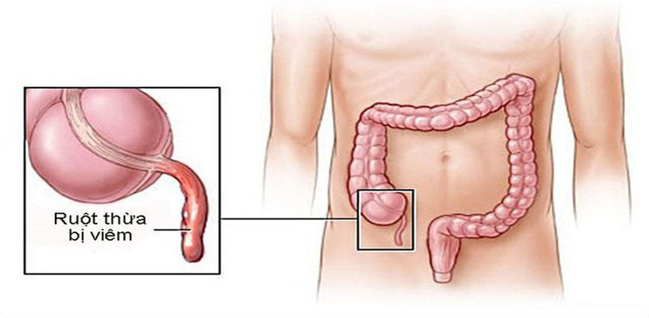 Viêm đường ruột nên ăn gì? hạn chế những triệu chứng