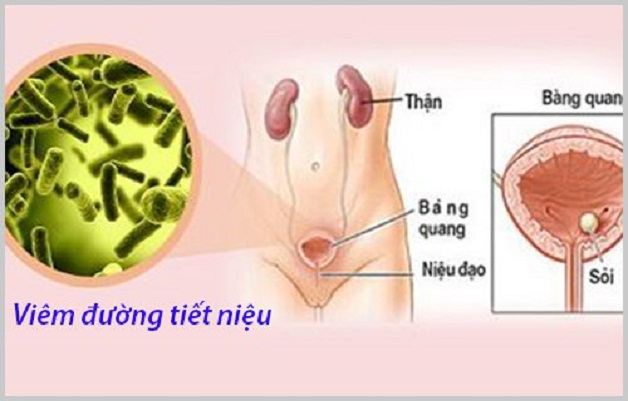 Viêm đường tiết niệu cần xét nghiệm gì?