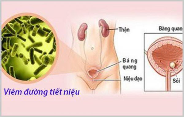 Viêm đường tiết niệu có tự khỏi không?