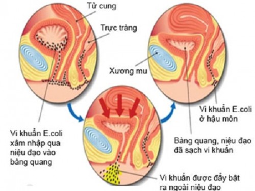 Viêm đường tiết niệu khi mang thai uống thuốc gì?