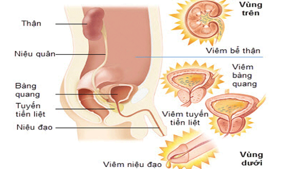 Viêm đường tiết niệu là gì và có nguy hiểm không?