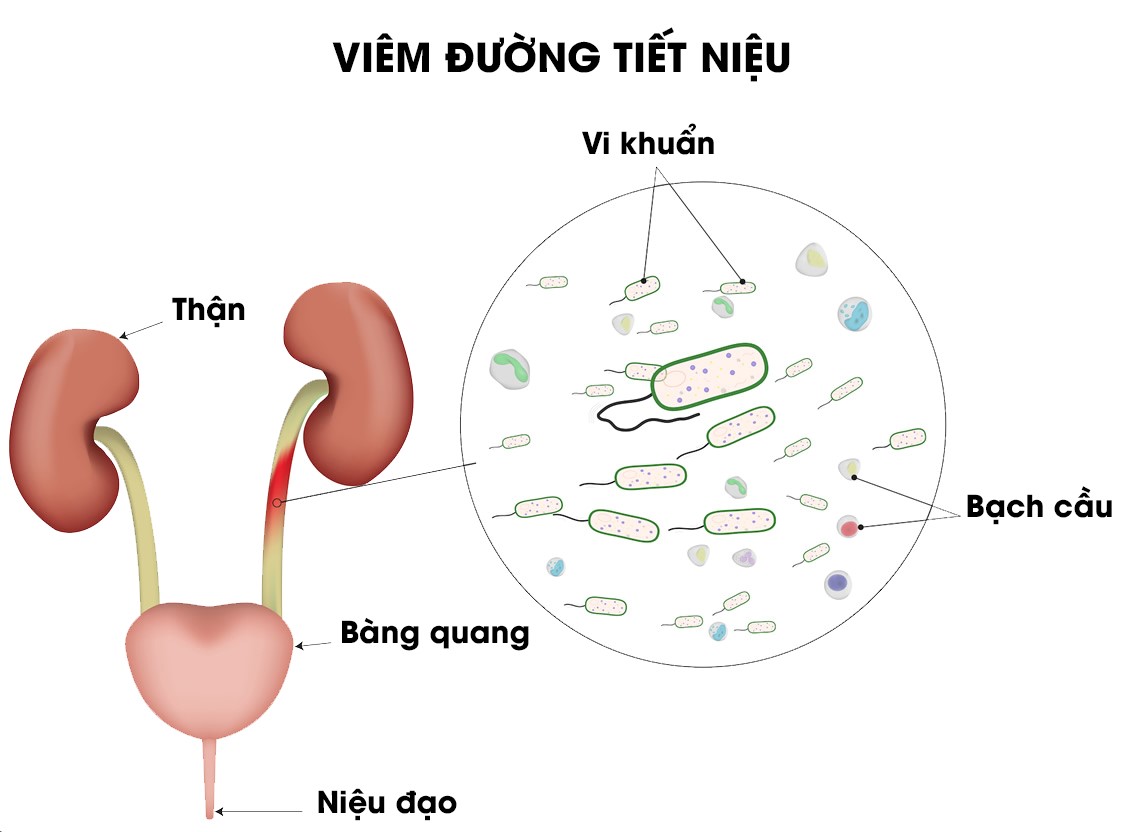 Viêm đường tiết niệu làm sao hết – Góc giải đáp