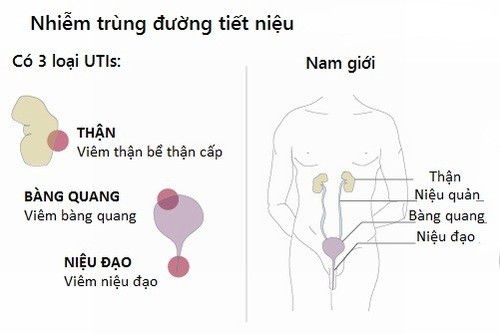 Viêm đường tiết niệu ở nam giới phải làm sao?