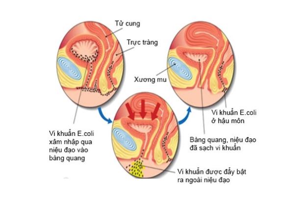 Viêm đường tiết niệu ở trẻ, cha mẹ chớ chủ quan