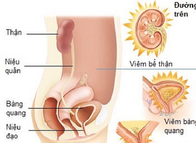 Viêm đường tiết niệu quan hệ có lây không và những lưu ý