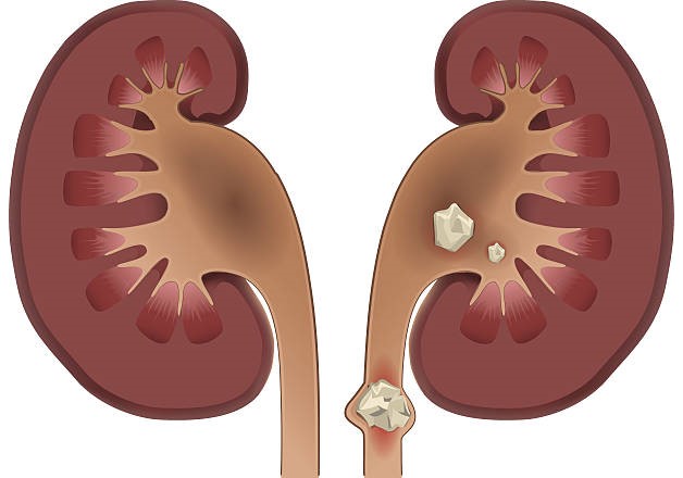 Viêm đường tiết niệu tái phát liên tục: Tại sao?