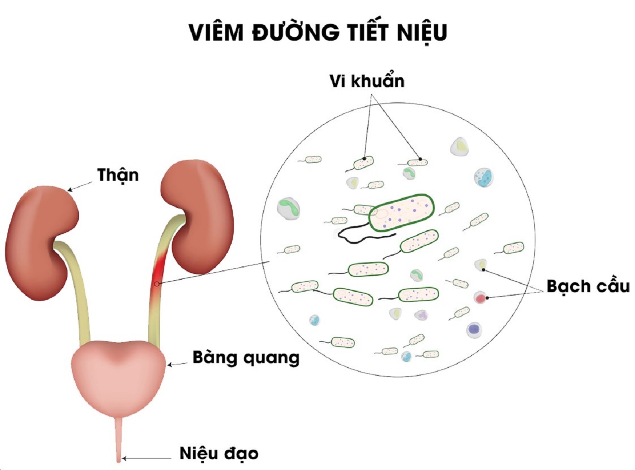 Viêm đường tiết niệu tiểu ra máu có nguy hiểm không?