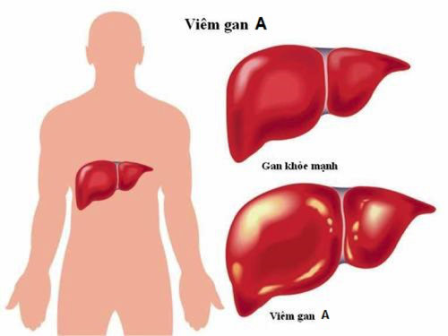 Viêm gan A là gì? Nguyên nhân, triệu chứng và cách khắc