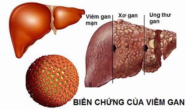 Viêm gan B biến chứng nguy hiểm