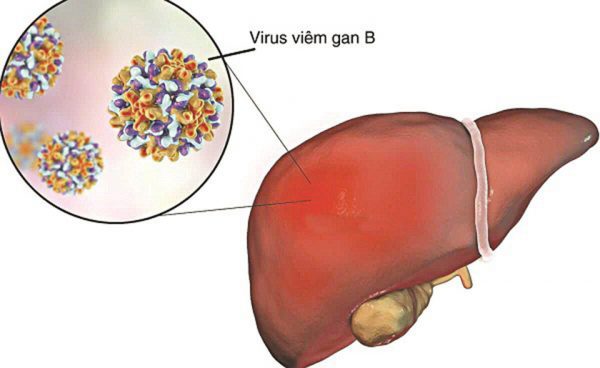 Viêm gan B là gì? Phân biệt các trường hợp viêm gan B