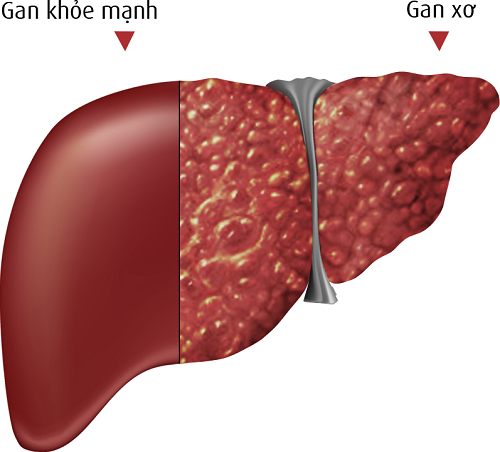 Viêm gan B mạn tính – bệnh nguy hiểm không nên xem nhẹ