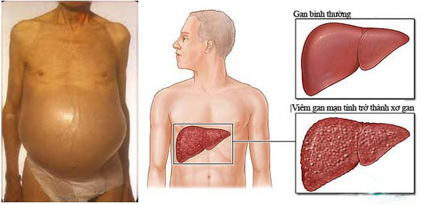 Viêm gan B mạn tính cần điều trị tích cực