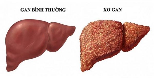 Viêm gan B mạn tính nguy hiểm hơn những gì bạn nghĩ