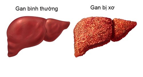 Viêm gan B – “sát thủ” thầm lặng