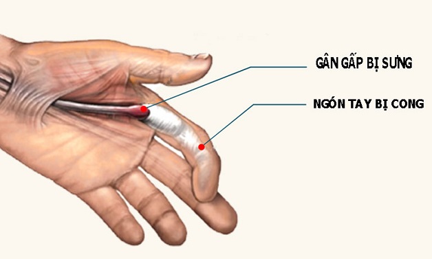 Viêm gân gấp ngón tay: Nguyên nhân, cách chẩn trị