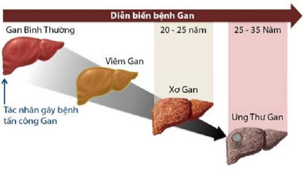 Viêm gan mạn là gì: Nguyên nhân, biểu hiện và điều trị như thế nào