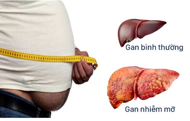 Viêm gan nhiễm mỡ không do rượu và điều cần biết