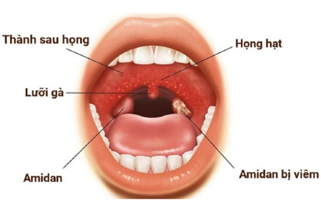 Viêm họng hạt mãn tính có nguy hiểm không? Cách điều trị?