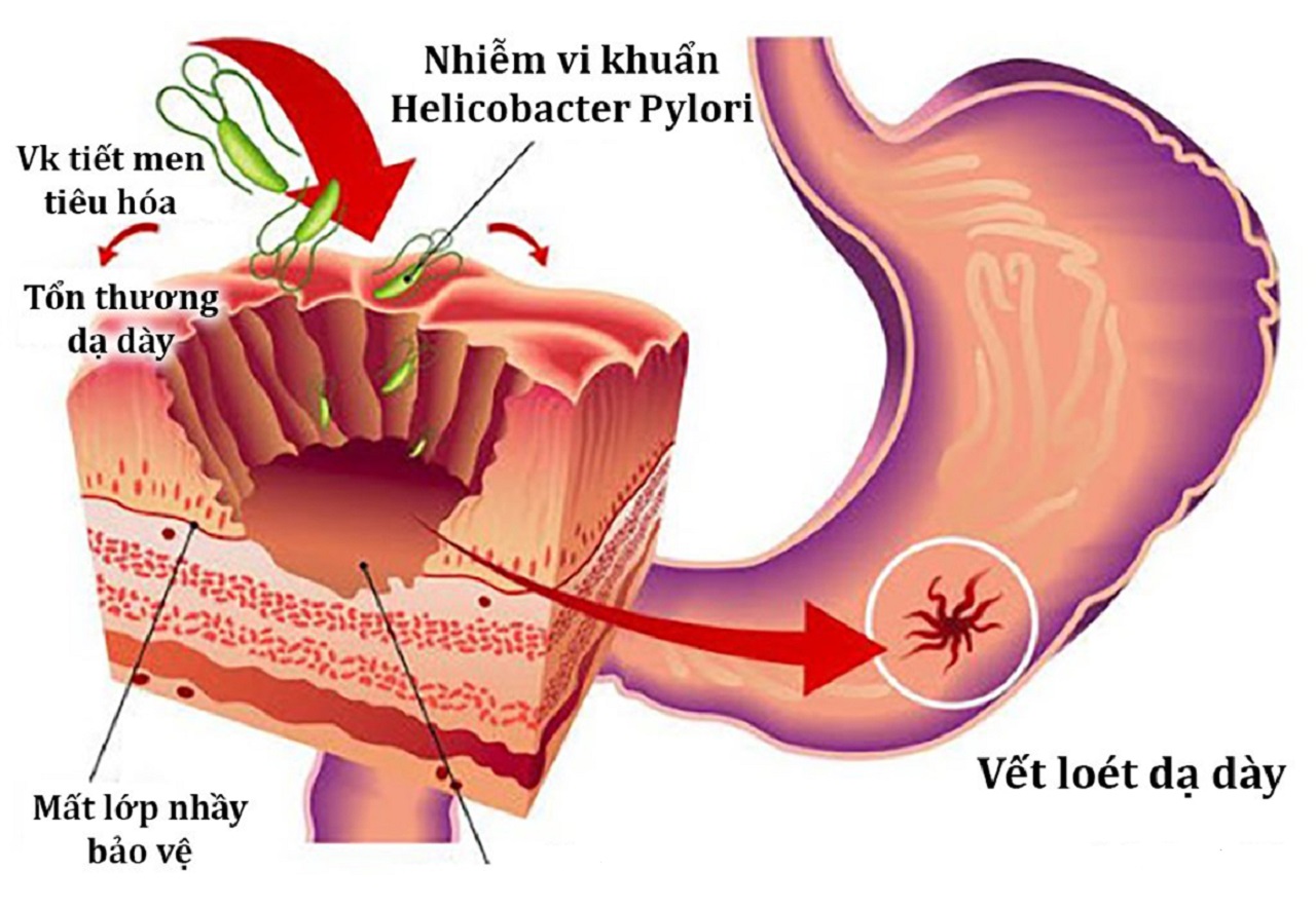 Viêm HP dạ dày có nguy hiểm không? Cách điều trị