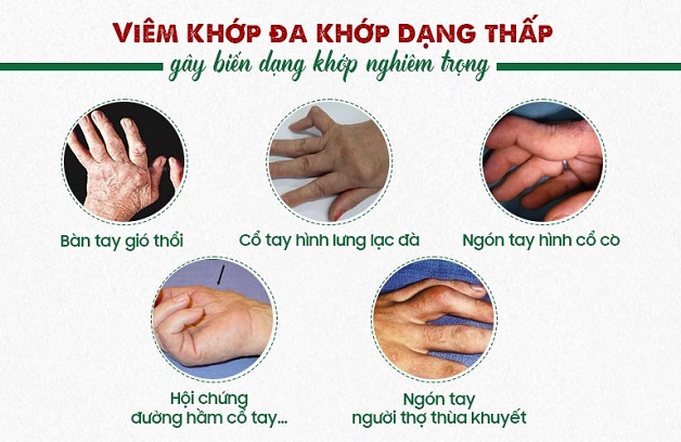 Viêm khớp dạng thấp bệnh học và những điều cần biết