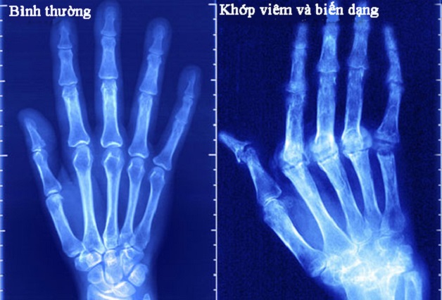 Viêm khớp dạng thấp bệnh học và những điều cần biết