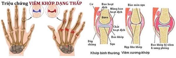 Viêm khớp dạng thấp là bệnh gì?