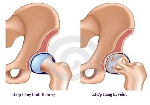 Viêm khớp háng ở nguời lớn, nguyên nhân và cách điều trị